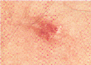 Semplice ha limitato neurodermatitis